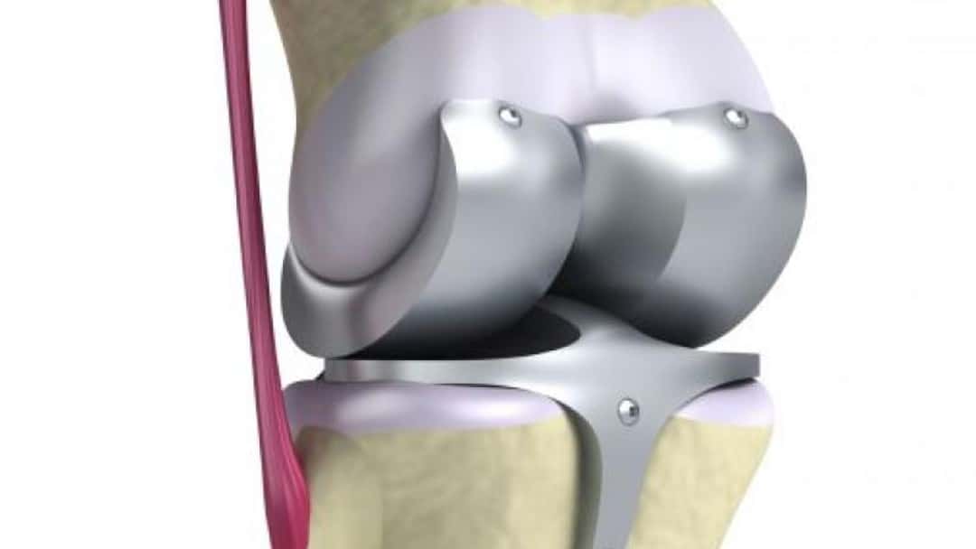 The ever-increasing cost of prosthetic limbs